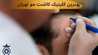 بهترین کلینیک کاشت مو تهران