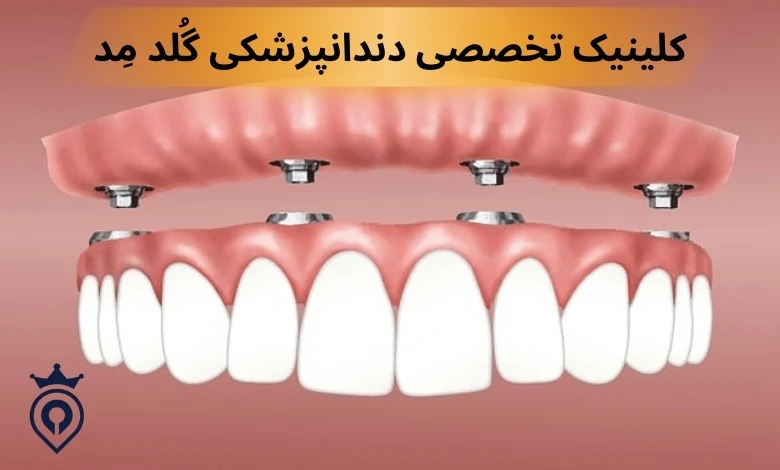 ایمپلنت دندان در میرداماد