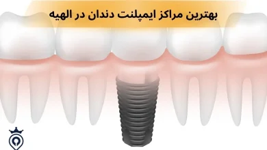 ایمپلنت دندان در الهیه