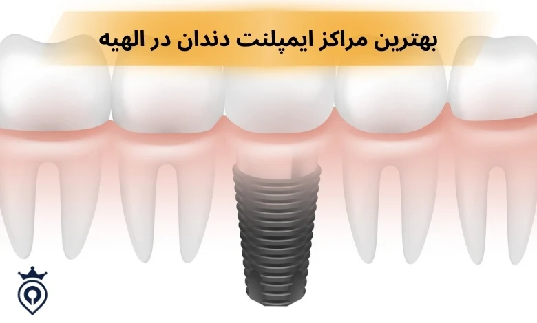 ایمپلنت دندان در الهیه