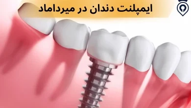 ایمپلنت دندان در تهران