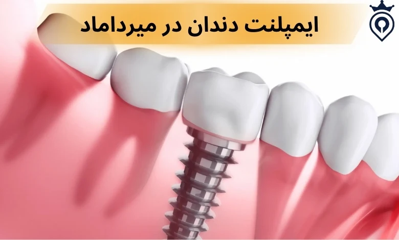 ایمپلنت دندان در تهران