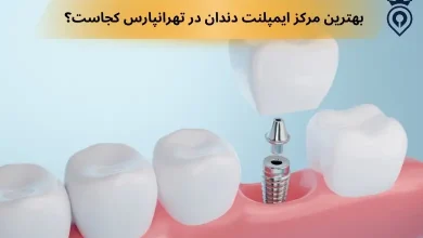 ایمپلنت دندان در تهرانپارس