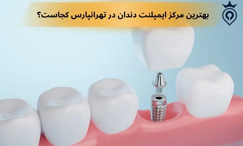 ایمپلنت دندان در تهرانپارس