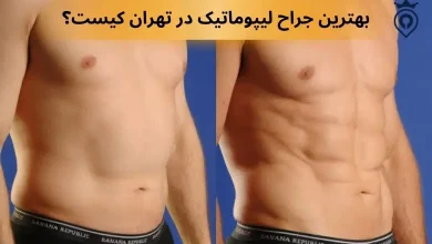 بهترین جراح لیپوماتیک در تهران