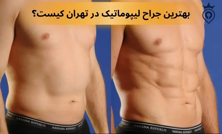 بهترین جراح لیپوماتیک در تهران
